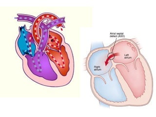 ATRIJALNI SEPTALNIATRIJALNI SEPTALNI
DEFEKT (ASD)DEFEKT (ASD)
 