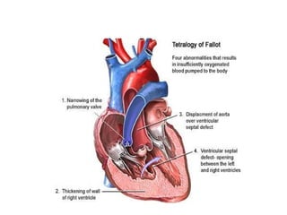 TETRALOGIJA FALLOTTETRALOGIJA FALLOT
 