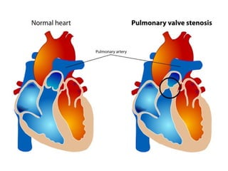 STENOZA ARTERIJESTENOZA ARTERIJE
PULMONALISPULMONALIS
 
