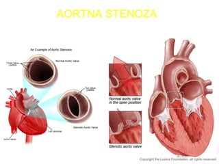STENOZA AORTESTENOZA AORTE
AORTNA STENOZA
 