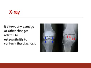 X-ray
It shows any damage
or other changes
related to
osteoarthritis to
conform the diagnosis
 