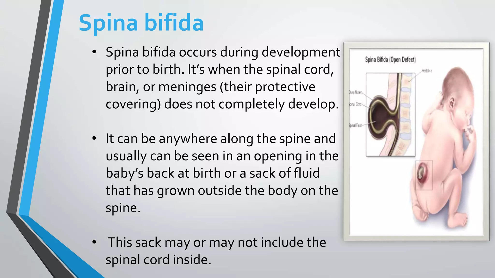 • Spina bifida occurs during development
prior to birth. It’s when the spinal cord,
brain, or meninges (their protective
covering) does not completely develop.
• It can be anywhere along the spine and
usually can be seen in an opening in the
baby’s back at birth or a sack of fluid
that has grown outside the body on the
spine.
• This sack may or may not include the
spinal cord inside.
Spina bifida
 