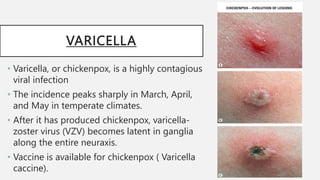 VARICELLA
• Varicella, or chickenpox, is a highly contagious
viral infection
• The incidence peaks sharply in March, April,
and May in temperate climates.
• After it has produced chickenpox, varicella-
zoster virus (VZV) becomes latent in ganglia
along the entire neuraxis.
• Vaccine is available for chickenpox ( Varicella
caccine).
 