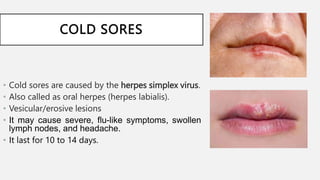 COLD SORES
• Cold sores are caused by the herpes simplex virus.
• Also called as oral herpes (herpes labialis).
• Vesicular/erosive lesions
• It may cause severe, flu-like symptoms, swollen
lymph nodes, and headache..
• It last for 10 to 14 days.
 