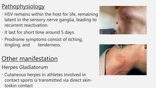 Pathophysiology
• HSV remains within the host for life, remaining
latent in the sensory nerve ganglia, leading to
recurrent reactivation.
• It last for short time around 5 days.
• Prodrome symptoms consist of itching,
tingling, and tenderness.
Other manifestation
Herpes Gladiatorum
• Cutaneous herpes in athletes involved in
contact sports is transmitted via direct skin-
toskin contact
 