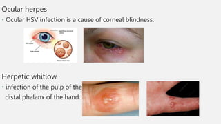 Ocular herpes
• Ocular HSV infection is a cause of corneal blindness.
Herpetic whitlow
• infection of the pulp of the
distal phalanx of the hand.
 