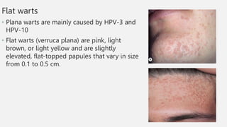 Flat warts
• Plana warts are mainly caused by HPV-3 and
HPV-10
• Flat warts (verruca plana) are pink, light
brown, or light yellow and are slightly
elevated, flat-topped papules that vary in size
from 0.1 to 0.5 cm.
 