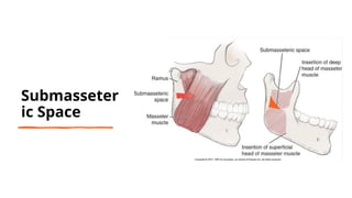 Submasseter Space Mandibular space infections Presentation3.pptx