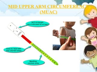 MID UPPER ARM CIRCUMFERENCE
(MUAC)
 