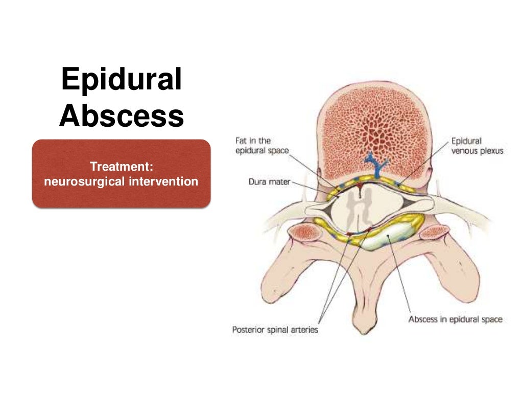 COMPLICATIONS OF SPINAL & EPIDURAL ANAESTHESIA