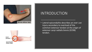 INTRODUCTION
• Lateral epicondylitis describes an over use
injury secondary to overload of the
common extensor tendon at the origin of
extensor carpi radialis brevis (ECRB)
tendon.
 