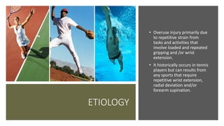 ETIOLOGY
• Overuse injury primarily due
to repetitive strain from
tasks and activities that
involve loaded and repeated
gripping and /or wrist
extension.
• It historically occurs in tennis
players but can results from
any sports that require
repetitive wrist extension,
radial deviation and/or
forearm supination.
 