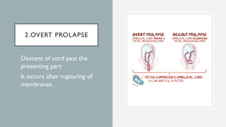 2.OVERT PROLAPSE
 Descent of cord past the
presenting part
 It occurs after rupturing of
membranes.
 