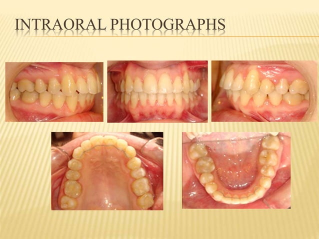 Transposition tooth corrected by orthodontic | PPT