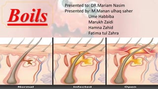 Boils
Presented to: DR.Mariam Nasim
Presented by: M.Manan ulhaq saher
Ume Habbiba
Marukh Zaidi
Hamna Zahid
Fatima tul Zahra
 