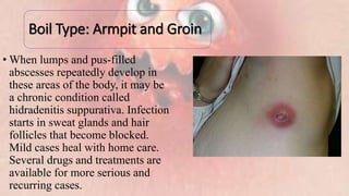 Boil Type: Armpit and Groin
• When lumps and pus-filled
abscesses repeatedly develop in
these areas of the body, it may be
a chronic condition called
hidradenitis suppurativa. Infection
starts in sweat glands and hair
follicles that become blocked.
Mild cases heal with home care.
Several drugs and treatments are
available for more serious and
recurring cases.
 