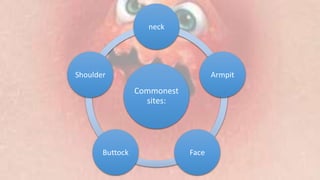 Commonest
sites:
neck
Armpit
Face
Buttock
Shoulder
 