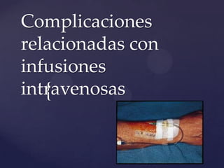 Complicaciones
relacionadas con
infusiones
intravenosas
   {
 
