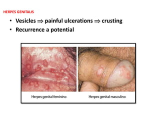 • Vesicles  painful ulcerations  crusting
• Recurrence a potential
HERPES GENITALIS
 