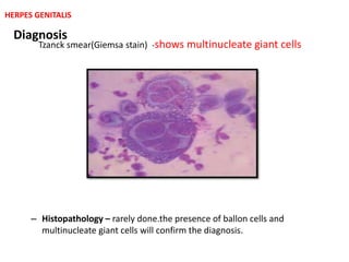 Diagnosis
– Histopathology – rarely done.the presence of ballon cells and
multinucleate giant cells will confirm the diagnosis.
Tzanck smear(Giemsa stain) -shows multinucleate giant cells
HERPES GENITALIS
 
