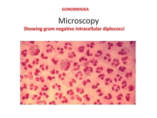 Microscopy
Showing gram negative intracellular diplococci
GONORRHOEA
 