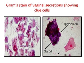 Gram’s stain of vaginal secretions showing
clue cells
 