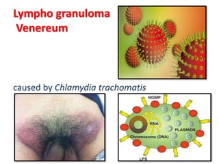 Lympho granuloma
Venereum
caused by Chlamydia trachomatis
 