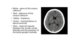 • White – genu of the corpus
callosum
• Red – splenium of the
corpus callosum
• Yellow – thalamus
• Green – choroid plexus in
lateral ventricle
• Blue – external capsule
between the insular cortex
laterally and the putamen of
the basal ganglia medially
 
