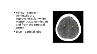 • Yellow – centrum
semiovale are
supraventricular white
matter tracts running to
and from the cerebral
cortex
• Blue – parietal lobe
 