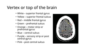 Vertex or top of the brain
• White – superior frontal gyrus
• Yellow – superior frontal sulcus
• Red – middle frontal gyrus
• Green – prefrontal sulcus
• Orange – motor strip or
prefrontal gyrus
• Blue – central sulcus
• Purple – sensory strip or post
central gyrus
• Pink – post central sulcus
 