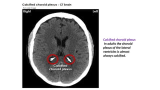 Calcified choroid plexus
In adults the choroid
plexus of the lateral
ventricles is almost
always calcified.
 