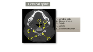 Cervical spine
1
3
4
5
2
1. Vertebral body
2. Spinous process
3. Pedicle
4. Lamina
5. Transverse foramen
 