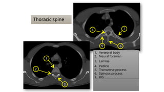 Thoracic spine
2
1
7
5 6
1. Vertebral body
2. Neural foramen
3. Lamina
4. Pedicle
5. Transverse process
6. Spinous process
7. Rib
3
4
 