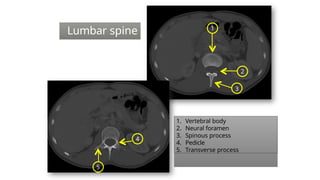 1
2
3
5
4
1. Vertebral body
2. Neural foramen
3. Spinous process
4. Pedicle
5. Transverse process
Lumbar spine
 
