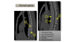 Dorsal spine
1
2
3
4
5
1. Vertebral body
2. Intrvertebral disc
3. Spinous process
4. Pedicle
5. Neural foramen
 