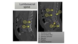 1
2
3
4
5
6
1. Vertebral body
2. Intrvertebral disc
3. Spinous process
4. Sacrum
5. Pedicle
6. Neural foramen
Lumbosacral
spine
 