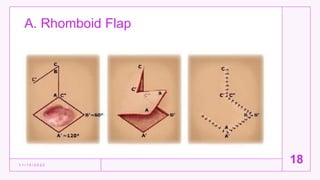 A. Rhomboid Flap
1 1 / 1 5 / 2 0 2 2
18
 