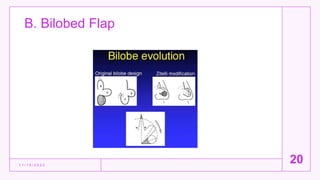 B. Bilobed Flap
1 1 / 1 5 / 2 0 2 2
20
 
