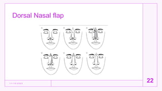 Dorsal Nasal flap
1 1 / 1 5 / 2 0 2 2
22
 