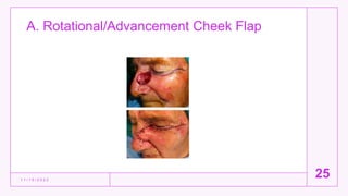 A. Rotational/Advancement Cheek Flap
1 1 / 1 5 / 2 0 2 2
25
 