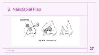 B. Nasolabial Flap
1 1 / 1 5 / 2 0 2 2
27
 