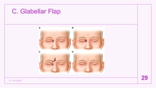 C. Glabellar Flap
1 1 / 1 5 / 2 0 2 2
29
 