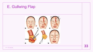 E. Gullwing Flap
1 1 / 1 5 / 2 0 2 2
33
 