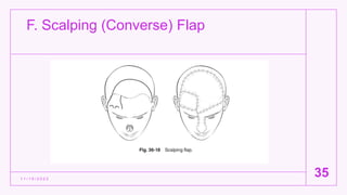 F. Scalping (Converse) Flap
1 1 / 1 5 / 2 0 2 2
35
 