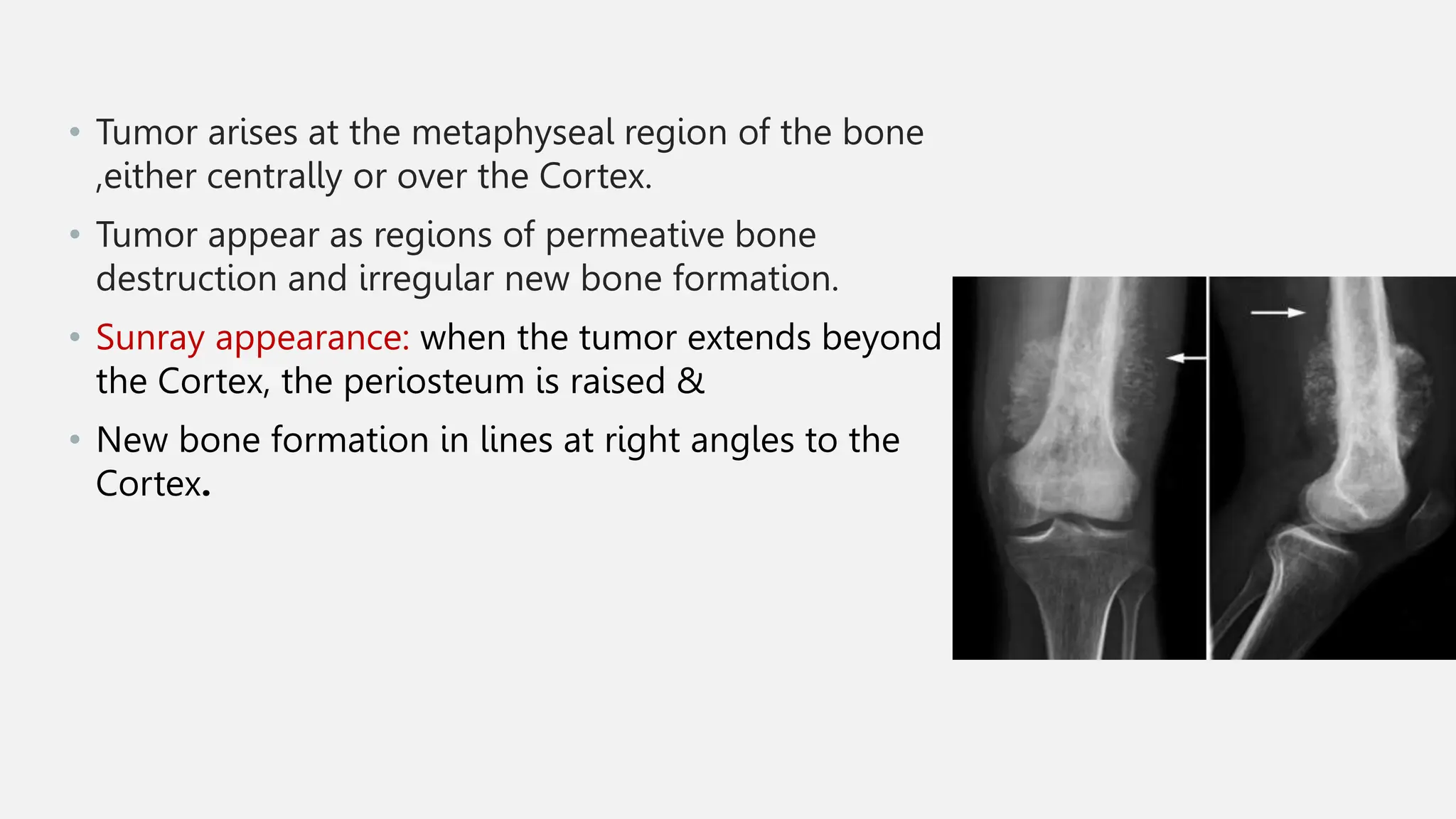 Presentation (4) (3).pptx Malignant bone tumours presentation ...