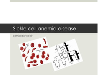 Sickle cell anemia disease
Lamia alkhudair
 