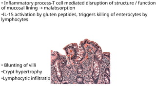 • Inflammatory process-T cell mediated disruption of structure / function
of mucosal lining malabsorption
→
•IL-15 activation by gluten peptides, triggers killing of enterocytes by
lymphocytes
• Blunting of villi
•Crypt hypertrophy
•Lymphocytic infiltration
 