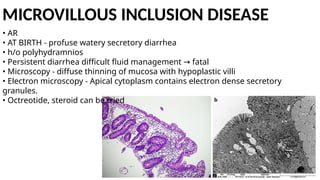 MICROVILLOUS INCLUSION DISEASE
• AR
• AT BIRTH - profuse watery secretory diarrhea
• h/o polyhydramnios
• Persistent diarrhea difficult fluid management fatal
→
• Microscopy - diffuse thinning of mucosa with hypoplastic villi
• Electron microscopy - Apical cytoplasm contains electron dense secretory
granules.
• Octreotide, steroid can be tried
 