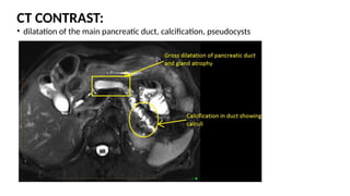CT CONTRAST:
• dilatation of the main pancreatic duct, calcification, pseudocysts
 