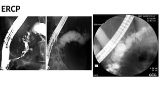 ERCP
 